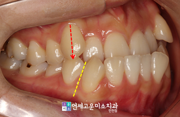 양악수술 없이 교정이 가능한 경우