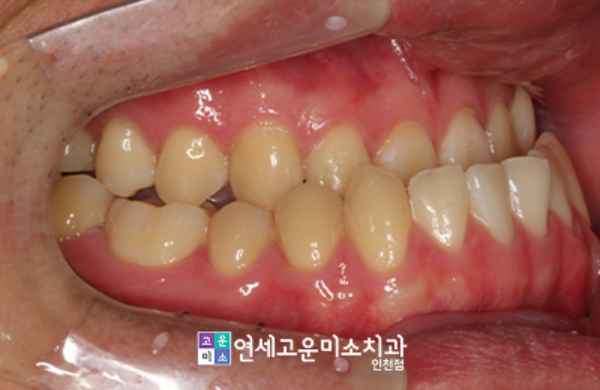 양악수술 하기 전 교합 상태