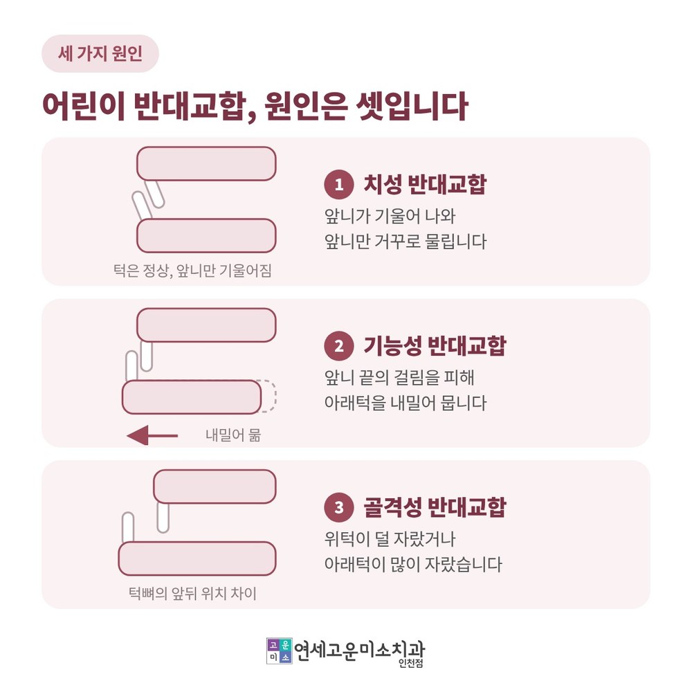 어린이 반대교합의 세 가지 원인 그림