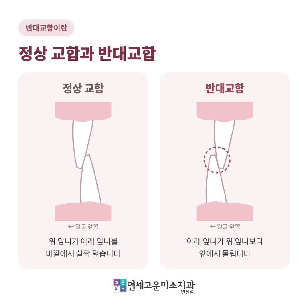 정상 교합과 반대교합 비교 그림