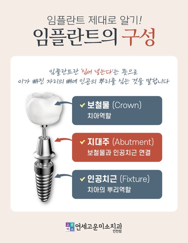 임플란트의 구성 (보철물, 지대주, 인공치근)