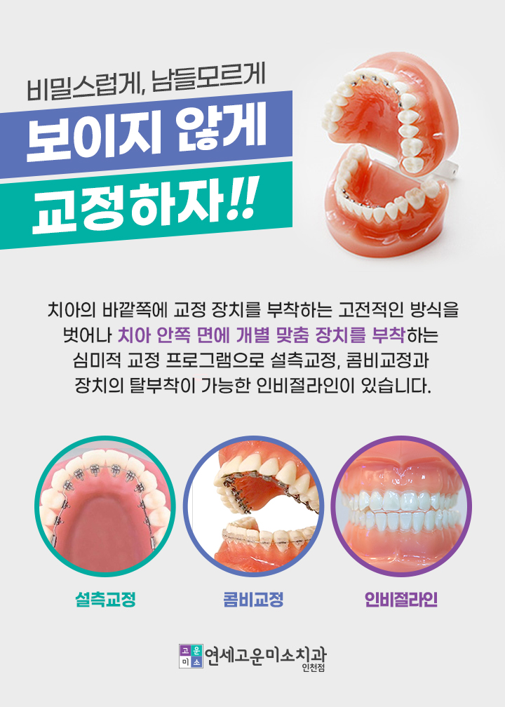 보이지 않는 교정 방법, 설측교정과 콤비교정, 인비절라인