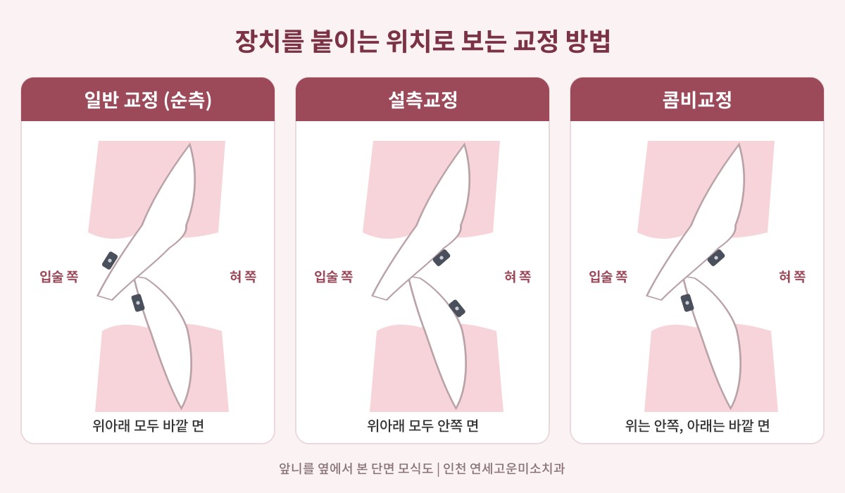 일반 교정, 설측교정, 콤비교정의 장치 위치 비교