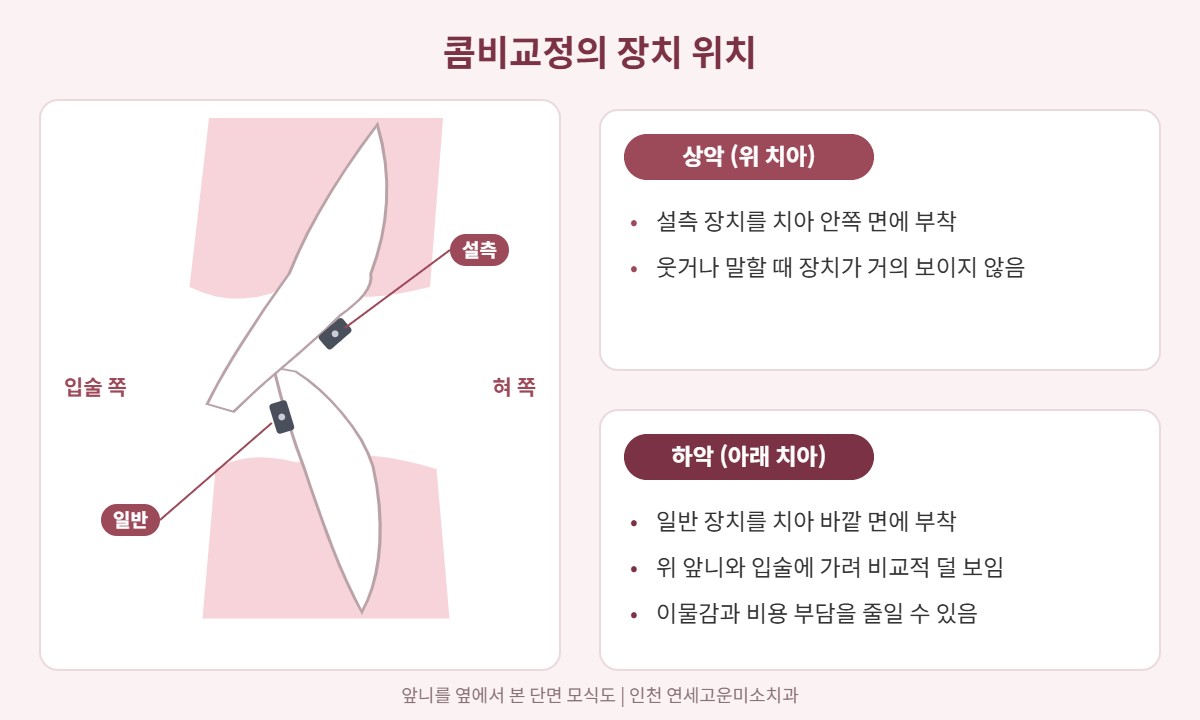 콤비교정의 장치 위치, 상악 설측 장치와 하악 일반 장치