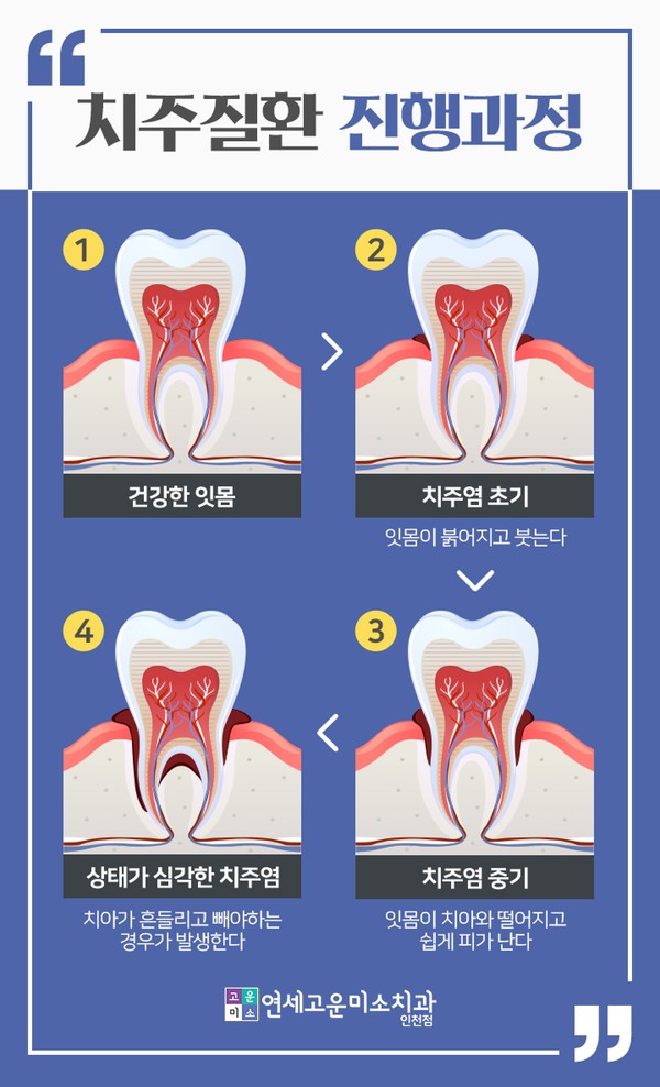 치주질환의 진행 과정