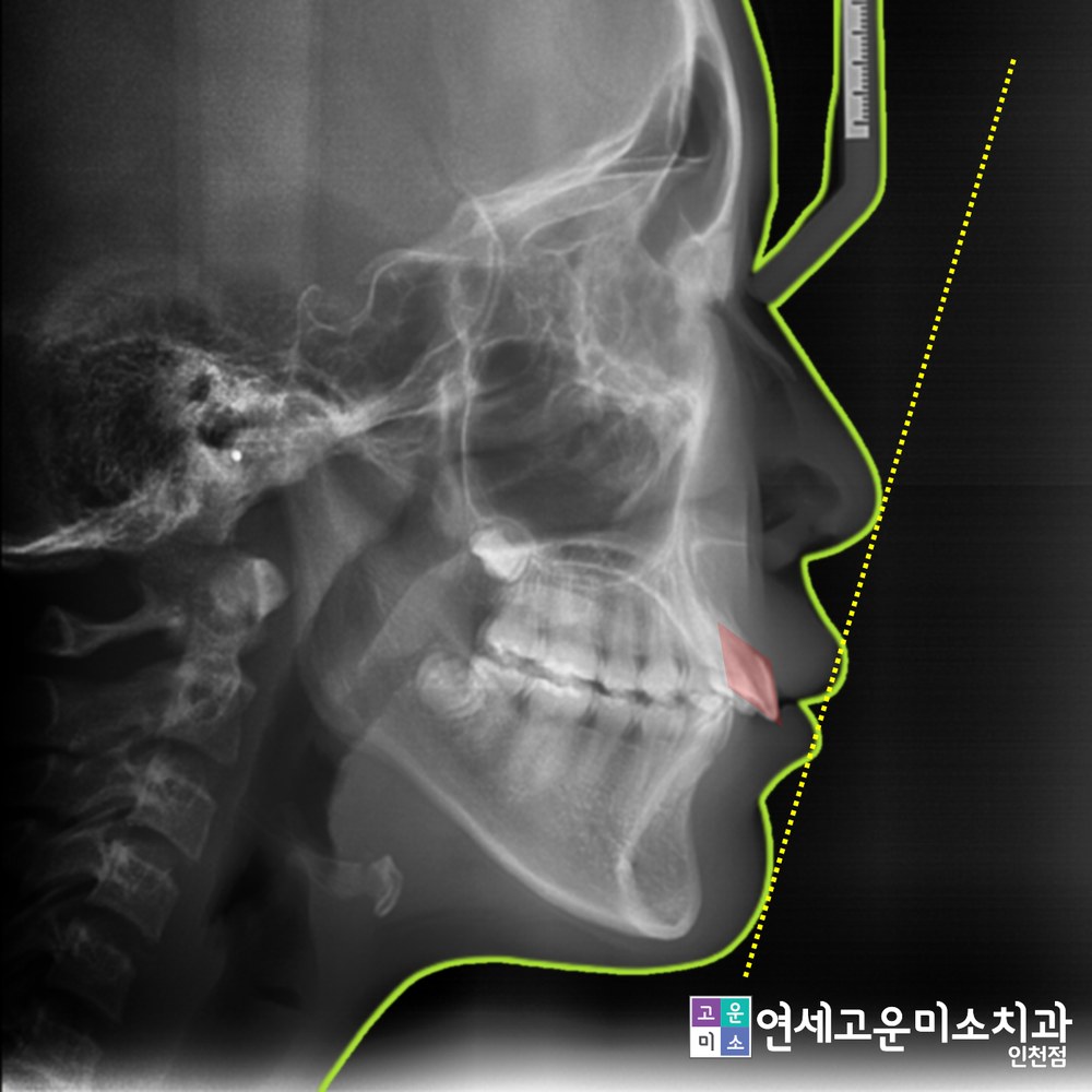 측면 엑스레이로 본 앞니와 입술의 관계