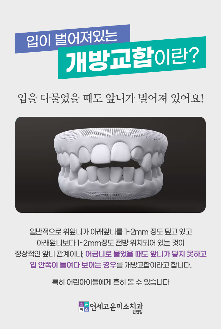 앞니가 잘 닿지 않는 개방교합
