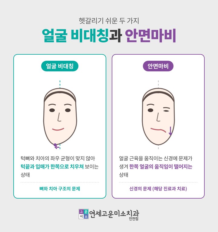 얼굴 비대칭과 안면마비의 차이
