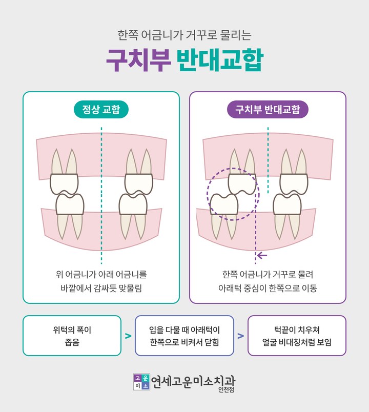 한쪽 어금니가 거꾸로 물리는 구치부 반대교합