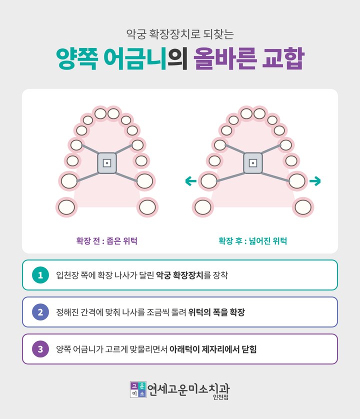 악궁 확장장치로 양쪽 어금니의 교합을 맞추는 과정