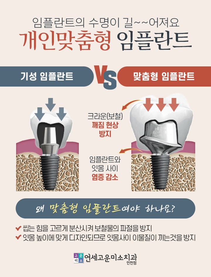개인 맞춤형 지대주를 사용한 임플란트