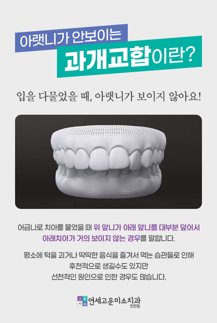 위 앞니가 아래 앞니를 깊게 덮는 과개교합