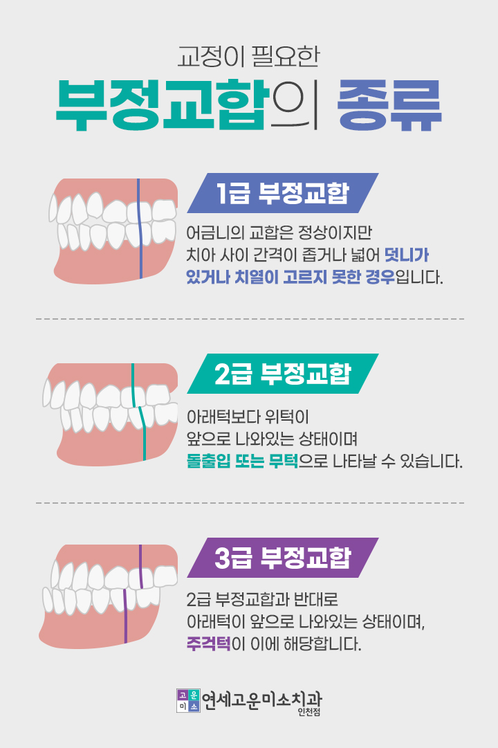 1급, 2급, 3급 부정교합의 종류
