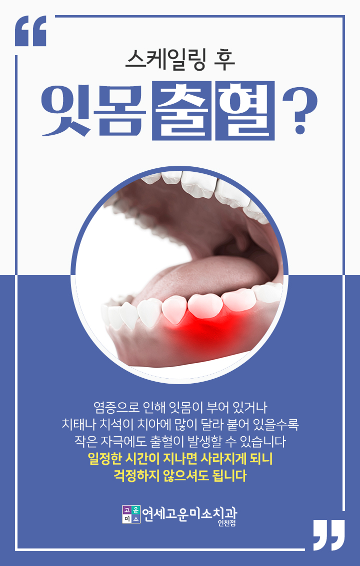 치석과 잇몸 염증으로 인한 잇몸 출혈