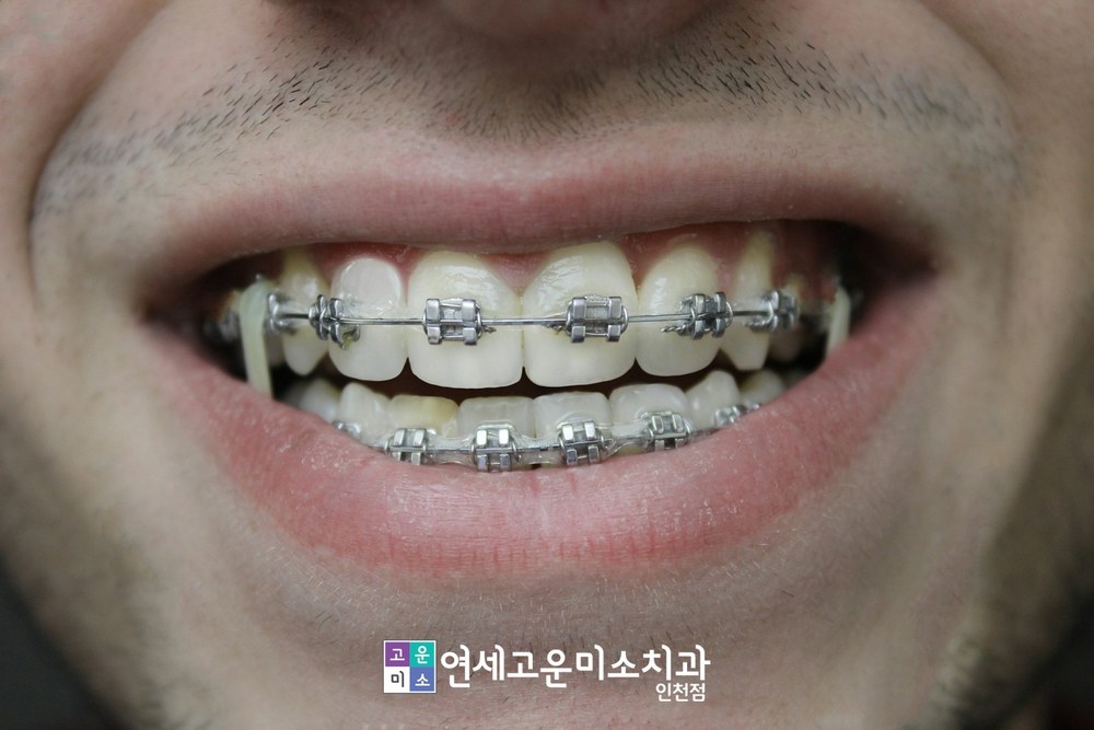 치아 바깥쪽에 붙이는 일반 교정장치